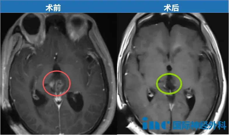 术前术后MRI对比