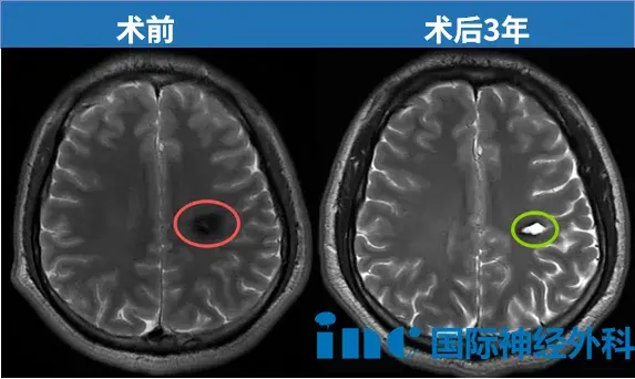 术后3年核磁