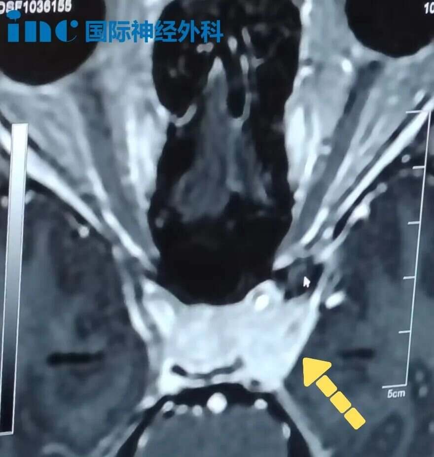 31岁的桐桐(化名)罹患鞍区及左侧海绵窦区占位性病变,包绕左侧颈内动脉C5-6段,大小约22mm×15mm×15mm。