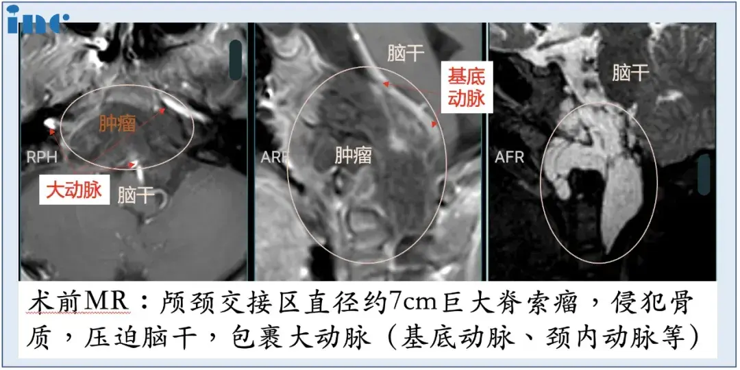 术前MR:颅颈交接区直径约7cm巨大脊索瘤,侵犯骨质,压迫脑干,包裹大动脉(基底动脉、颈内动脉等)