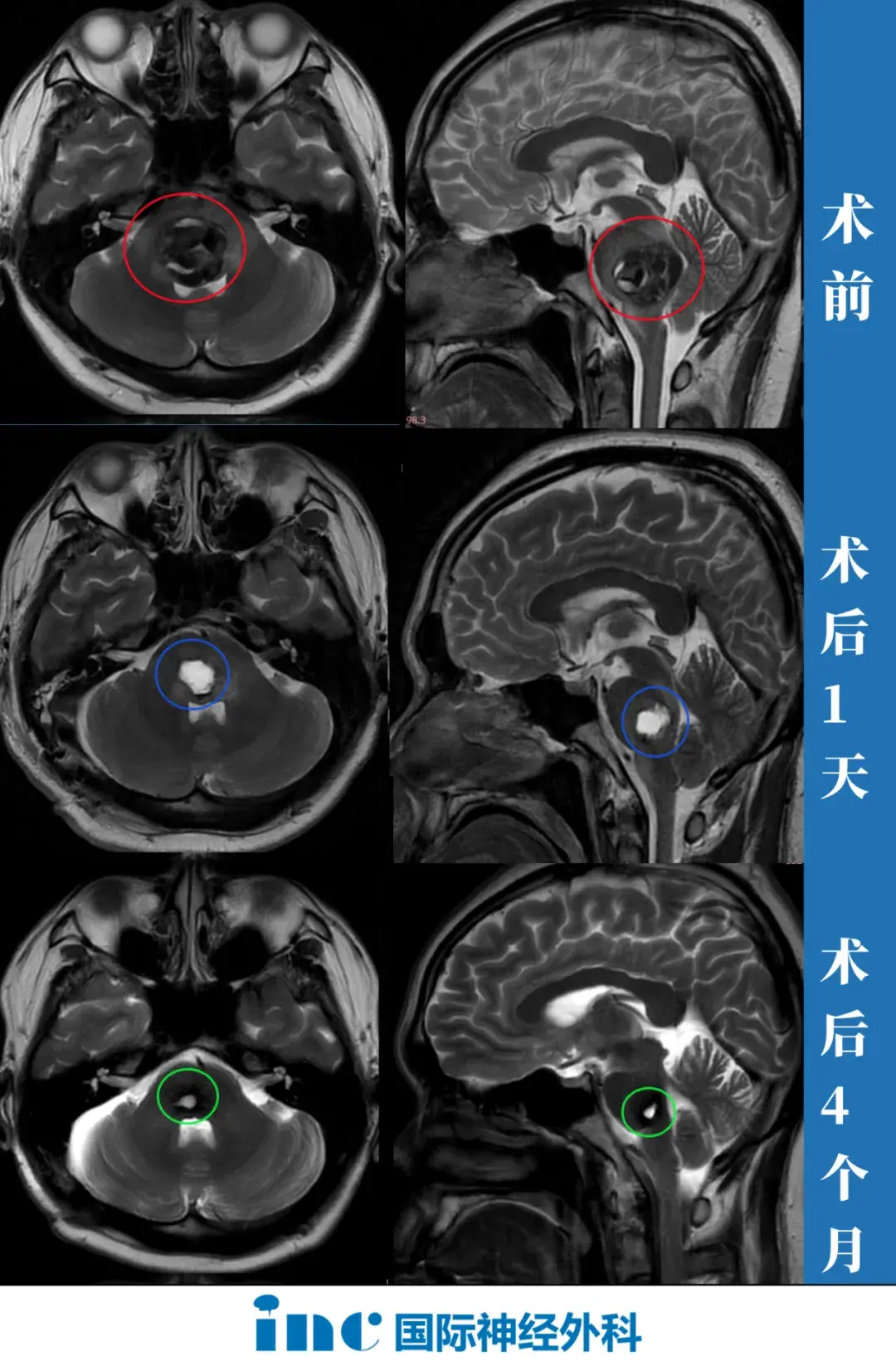 术前术后影像对比