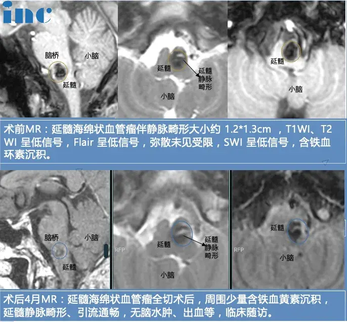 图片：术后四个月随访影像对比，冯先生术前术后脑干MRI，示海绵状血管瘤全切、残留静脉畸形