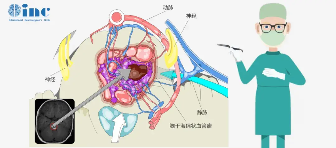 冯先生的术后4个月随访影像中显示的静脉畸形，是由于脑干深部的引流静脉