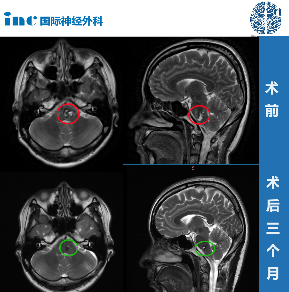 术前 术后三个月