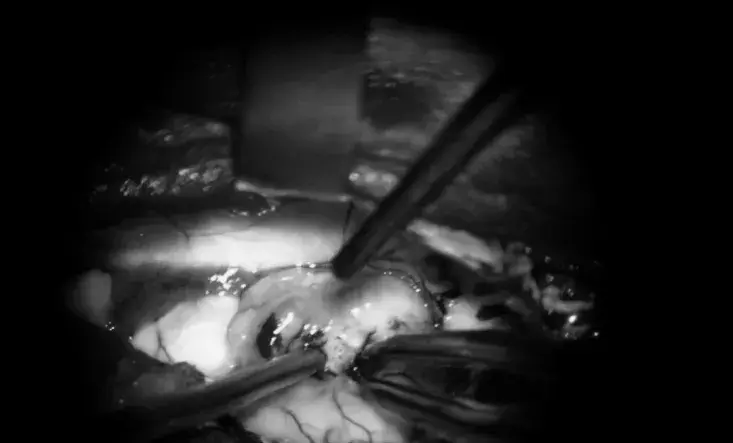 通过经蝶窦切除术，同时进行隔膜切开术，成功切除肿瘤。
