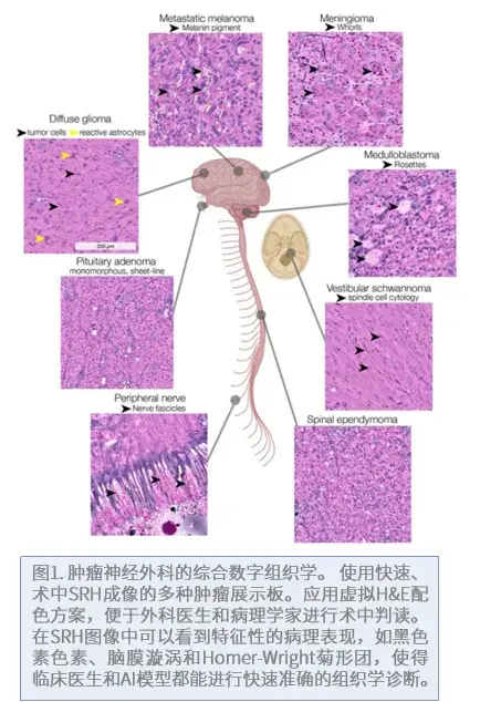 该模型在复发性弥漫性胶质瘤患者的外部测试队列中达到了95.8%的分类准确率。