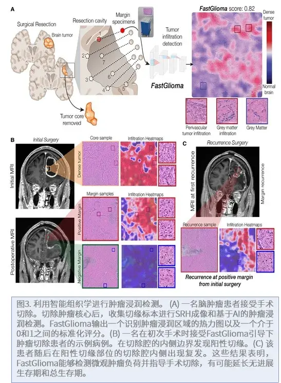 FastGlioma是一种用于快速检测手术切缘的胶质瘤浸润的智能组织学模型。