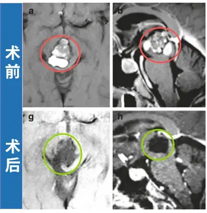 术中及术后MRI均证实海绵状血管瘤已完全切除