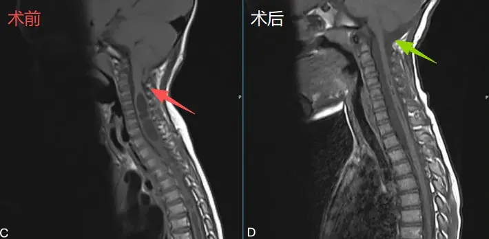 (术后术区示意)