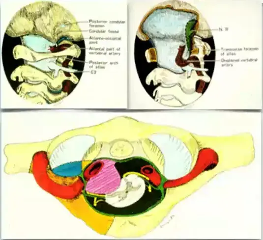 The Dorsolateral, Suboccipital, Transcondylar Approach to the Lower Clivus and Anterior Portion of the Craniocervical Junction