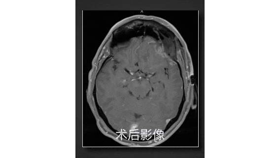 术后MRI显示肿瘤已完全切除
