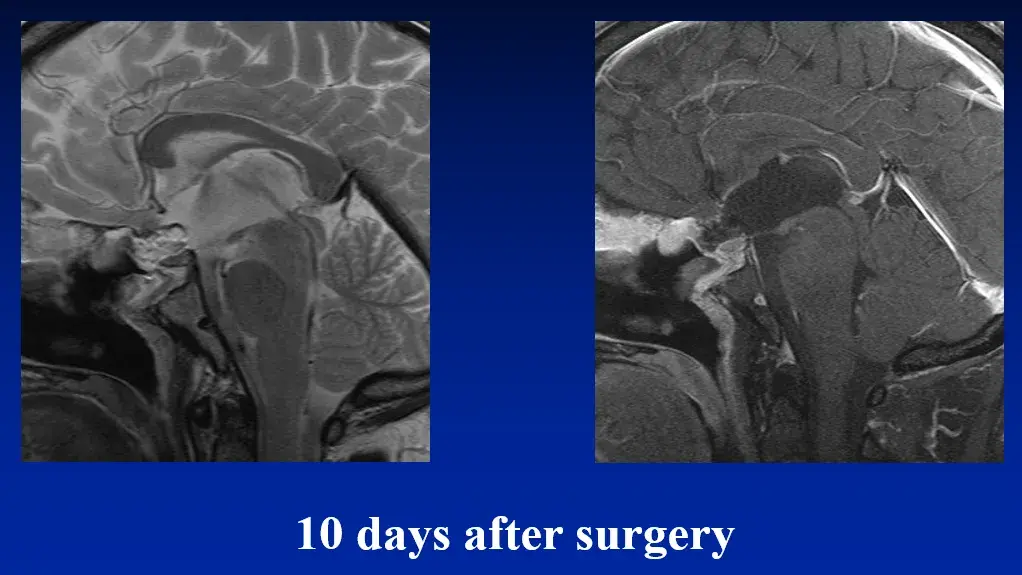 10 days after surgery（术后10天）