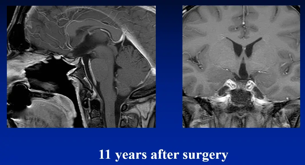 11 years after surgery（术后11年）