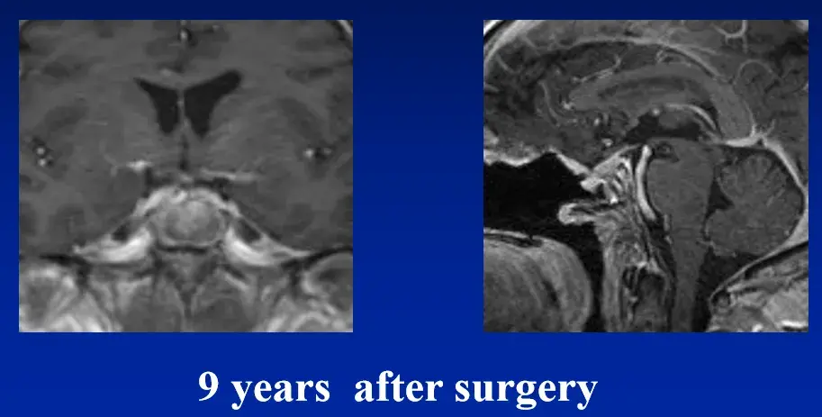 9 years after surgery（术后9年）