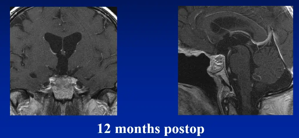 12 months postop（术后12个月）