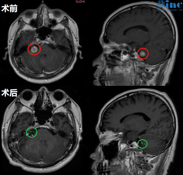 术后第一天巴教授ICU查房，袁先生意识清楚，四肢活动正常，术后无即时面瘫，面部功能表情正常。