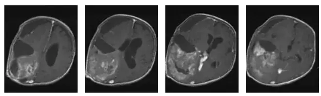 术前MRI