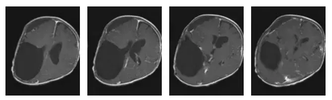 术前MRI