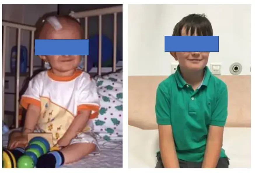 该小患者术后（左）及12岁时（右）的照片，快乐长大的他。