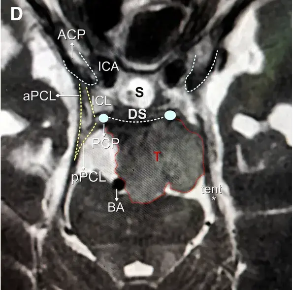 术前MRI