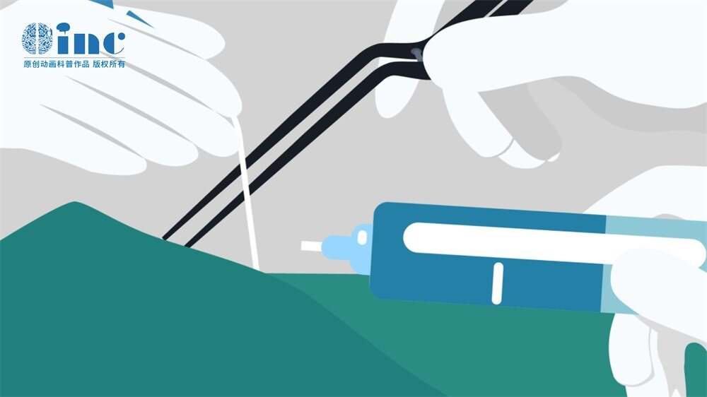 岩斜区在颅底正中央,前面是鞍旁和海绵窦,后面是脑干和基底动脉,两侧有多对颅神经穿行,底下是枕大孔。肿瘤长在岩斜区,四面八方全是关键结构,任何操作不当都有严重后果。