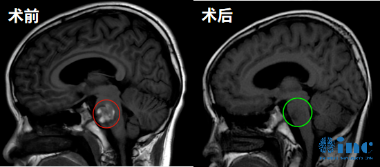 术前术后核磁