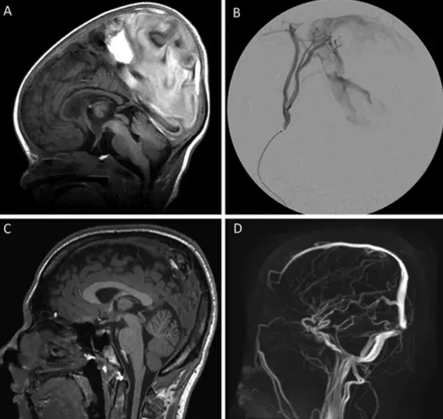 A：初始 MRI 显示后部上矢状窦和窦汇区域的巨大静脉囊。B：选择性血管造影显示来自双侧脑膜中动脉的动脉血流，并进行 NBCA 胶栓塞。C 和 D：16 年随访影像显示 tDSM 大幅退化，窦汇静脉解剖结构重塑为正常口径。