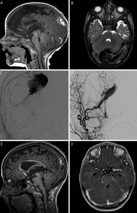 A 和 B：初始 MRI 显示后部上矢状窦、窦汇、左侧横窦近端和直窦的巨大 tDSM。C 和 D：选择性血管造影显示来自双侧脑膜中动脉和枕动脉的硬脑膜动静脉分流。E 和 F：治疗后影像显示 tDSM 退化，并通过左侧海绵窦形成代偿性静脉回流。