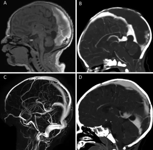 A 和 B：初始 MRI 和 CT 静脉造影显示后部上矢状窦、窦汇和双侧内侧横窦的巨大 tDSM，伴有大的非闭塞性血栓。C 和 D：10 个月随访影像显示畸形显著缩小，硬脑膜窦重塑并保持通畅。