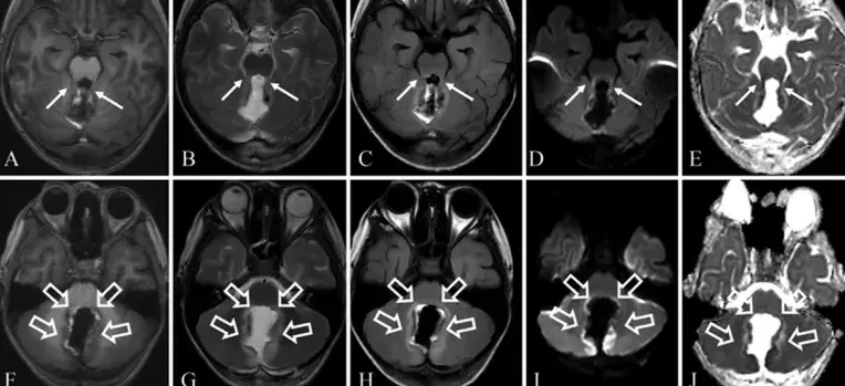 小脑性缄默综合征(post-operative pediatric cerebellar mutism syndrome)