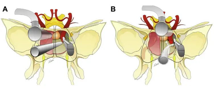 (A) 双鼻孔和 (B) 带成角器械的单鼻孔入路。可旋转的轴与吸引器成角相结合,使得手指的微小动作在暴露深处被放大,并允许360°的覆盖范围。当由拇指和食指、中指控制时,吸引器也可以前后移动。
