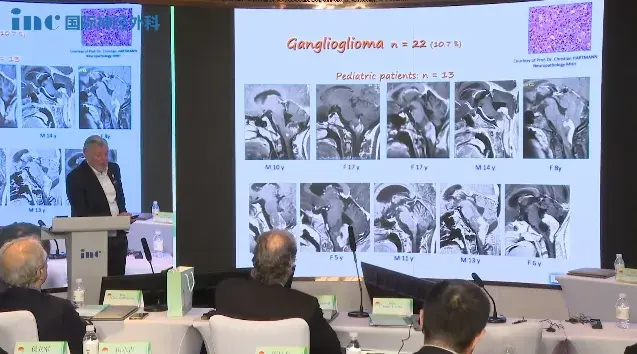 巴教授进行节细胞胶质瘤相关案例演讲