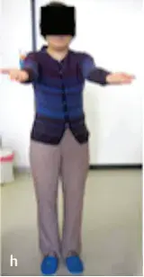 术后11年随访，患者一直无症状，生活可以自理（图h）