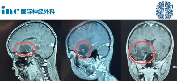 本来没症状的良性脑瘤,第一刀切出了癫痫,第二刀却让儿子恢复正常!