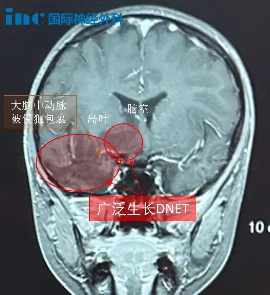 肿瘤已经长在基底节的运动纤维和下丘脑内部,正常组织和肿瘤组织相互交叉在一起,保护这些纤维不受损伤,对于这个即将进入青春期的男孩来说至关重要。