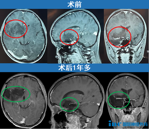 复查结果显示肿瘤的切除效果非常理想,局部血管及其他重要结构均得到完整保留。