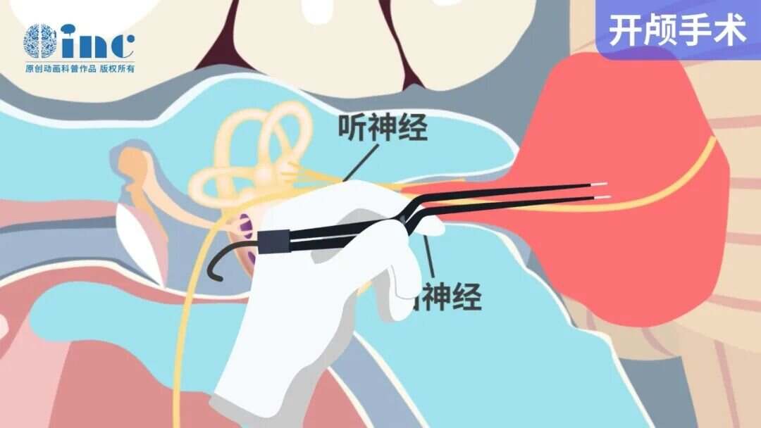 听神经瘤手术后面瘫,还有机会恢复吗?关键在这6个月